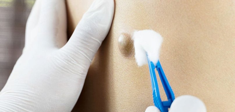 Choroba pilonidalna – jak rozpoznać problem i kiedy konieczne jest leczenie?