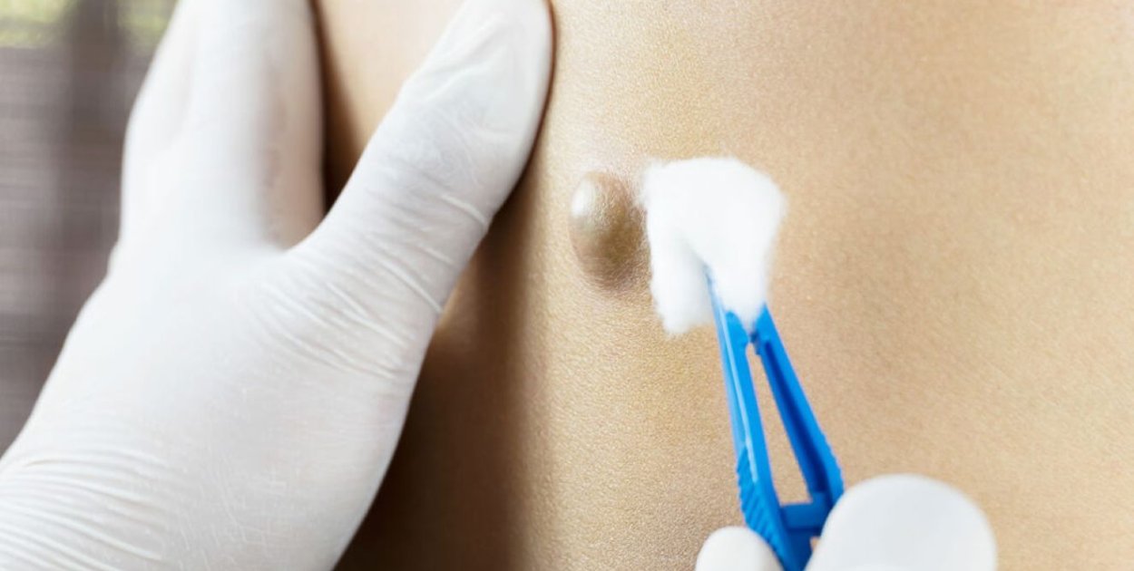 Choroba pilonidalna – jak rozpoznać problem i kiedy konieczne jest leczenie?